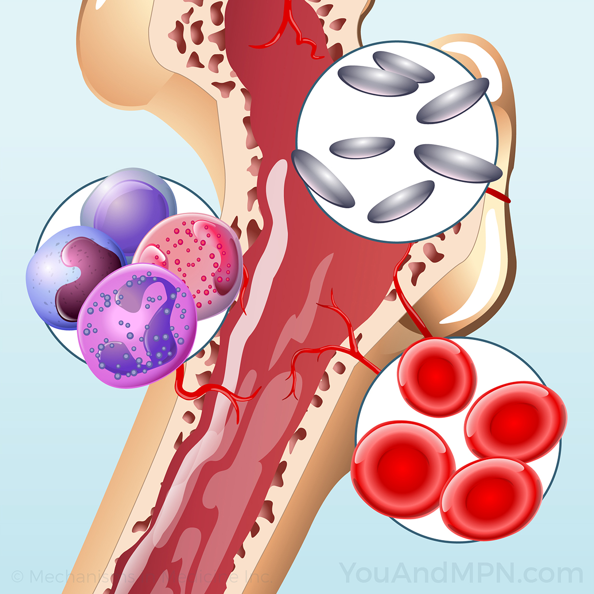 Myelofibrosis (MF)